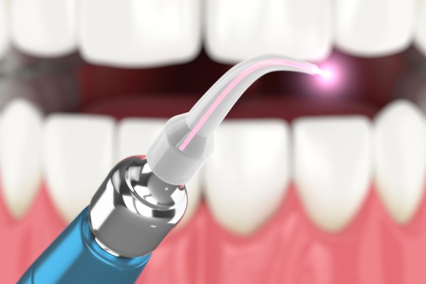 The Safety Benefits Of Laser Dentistry