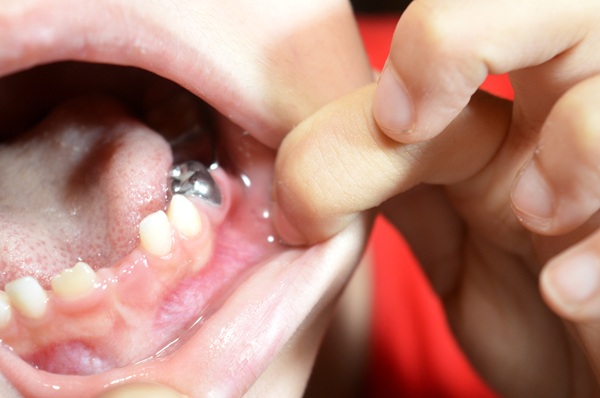What Happens During A Pulpotomy For Kids?